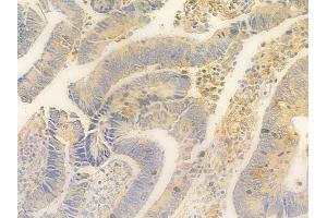 ABIN7095361 and ABIN7099418 at 1/100 staining human colon carcinoma by IHC-P. (ORMDL3 Antikörper)