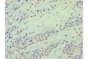 Immunohistochemistry of paraffin-embedded human breast cancer using ABIN7145117 at dilution of 1:100 (ATG9A Antikörper  (AA 180-290))