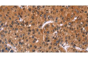 Immunohistochemistry of paraffin-embedded Human liver cancer using ING2 Polyclonal Antibody at dilution of 1:40 (ING2 Antikörper)