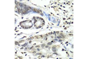 Immunohistochemistry of paraffin-embedded human gastric cancer using HIF1AN antibody (ABIN5973179) at dilution of 1/100 (40x lens).