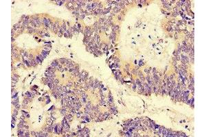 Immunohistochemistry of paraffin-embedded human colon cancer using ABIN7169300 at dilution of 1: 100 (PGAM5 Antikörper  (AA 30-223))