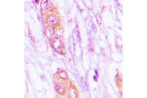 Immunohistochemical analysis of MELK staining in human lung cancer formalin fixed paraffin embedded tissue section. (MELK Antikörper  (Center))