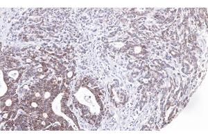 IHC-P Image Immunohistochemical analysis of paraffin-embedded human gastric cancer, using UBE2M, antibody at 1:100 dilution.