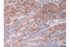 Detection of ACVR2A in Human Stomach Cancer Tissue using Polyclonal Antibody to Activin A Receptor Type II A (ACVR2A)