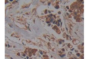 DAB staining on IHC-P; Samples: Human Breast cancer Tissue (NUP37 Antikörper  (AA 34-279))