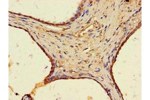 Immunohistochemistry of paraffin-embedded human prostate cancer using ABIN7175675 at dilution of 1:100