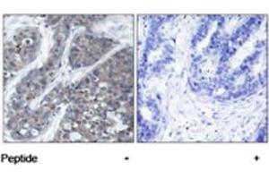 Immunohistochemical analysis of paraffin-embedded human breast carcinoma tissue using PTK2B polyclonal antibody  .