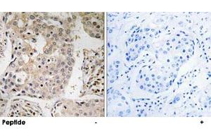 Immunohistochemistry analysis of paraffin-embedded human breast carcinoma tissue, using MRPL41 polyclonal antibody . (MRPL41 Antikörper)