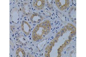 Immunohistochemistry of paraffin-embedded Human kidney cancer using MVP Polyclonal Antibody at dilution of 1:200 (40x lens).
