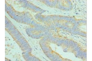 Immunohistochemistry of paraffin-embedded human colon cancer using ABIN7149525 at dilution of 1:100 (DCAF7 Antikörper  (AA 1-342))