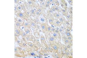 Immunohistochemistry of paraffin-embedded human liver cancer using PTGS1 antibody (ABIN5975503) at dilution of 1/100 (40x lens). (PTGS1 Antikörper)