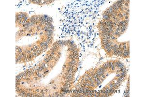 Immunohistochemistry of Human cervical cancer using SIPA1 Polyclonal Antibody at dilution of 1:40 (SIPA1 Antikörper)