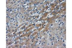 Immunohistochemical staining of paraffin-embedded Carcinoma of liver tissue using anti-LIPG mouse monoclonal antibody. (LIPG Antikörper)