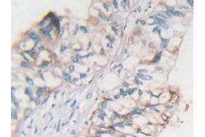 IHC-P analysis of Human Rectum Cancer Tissue, with DAB staining. (MSTN Antikörper  (AA 266-375))