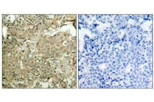 Immunohistochemical analysis of paraffin-embedded human breast carcinoma tissue using cofilin(Phospho-Ser3) Antibody(left) or the same antibody preincubated with blocking peptide(right). (Cofilin Antikörper  (pSer3))