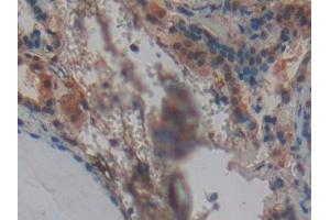 Detection of SNCG in Human Thyroid Tissue using Polyclonal Antibody to Gamma-synuclein (SNCG) (SNCG Antikörper  (AA 1-121))