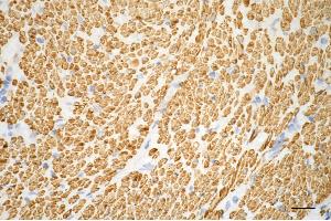 Immunohistochemistry was performed on paraffin-embedded human sigmoid colon carcinoma using alpha smooth muscle actin antibody (ABIN7797462), 1:500). (Rekombinanter Smooth Muscle Actin Antikörper)