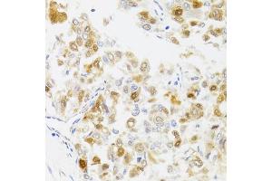 Immunohistochemistry of paraffin-embedded human liver cancer using MYO5A antibody. (MYO5A Antikörper)