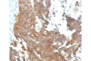 Formalin-fixed, paraffin-embedded human ovarian carcinoma stained with GnRH Receptor antibody (GNRHR/768)