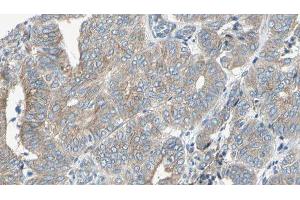 ABIN6276702 at 1/100 staining Human cervical cancer tissue by IHC-P. (NQO1 Antikörper  (C-Term))