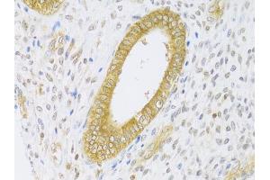 Immunohistochemistry of paraffin-embedded human adenomyosis using RAB27A Antibody (ABIN5970998) at dilution of 1/100 (40x lens). (RAB27A Antikörper)