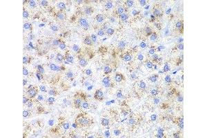 Immunohistochemistry of paraffin-embedded Human liver cancer using HAO1 Polyclonal Antibody at dilution of 1:200 (40x lens). (HAO1 Antikörper)
