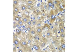 Immunohistochemistry of paraffin-embedded human liver injury using TLK2 antibody (ABIN5974098) at dilution of 1/100 (40x lens).