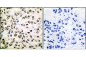 Immunohistochemistry analysis of paraffin-embedded human breast carcinoma tissue, using CREB-BP Antibody. (CBP Antikörper  (AA 2393-2442))