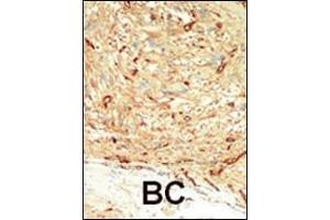 Formalin-fixed and paraffin-embedded human cancer tissue reacted with the primary antibody, which was peroxidase-conjugated to the secondary antibody, followed by DAB staining. (MST1 Antikörper  (C-Term))