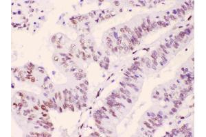 PML Protein was detected in paraffin-embedded sections of human intetsinal cancer tissues using rabbit anti- PML Protein Antigen Affinity purified polyclonal antibody (Catalog # ) at 1 ? (PML Antikörper  (N-Term))