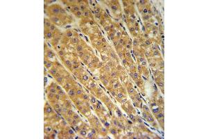 CP Antibody (Center) (ABIN391513 and ABIN2841474) IHC analysis in formalin fixed and paraffin embedded human hepatocarcinoma followed by peroxidase conjugation of the secondary antibody and DAB staining. (Ceruloplasmin Antikörper  (Center))