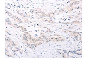 The image on the left is immunohistochemistry of paraffin-embedded Human colon cancer tissue using ABIN7131156(SPATA16 Antibody) at dilution 1/25, on the right is treated with fusion protein.