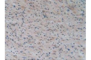 IHC-P analysis of Human Glioma Tissue, with DAB staining. (APOA2 Antikörper  (AA 24-100))