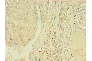 Immunohistochemistry of paraffin-embedded human lung cancer using ABIN7172152 at dilution of 1:100 (THRB Antikörper  (AA 1-461))