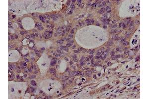 Immunohistochemistry of paraffin-embedded human colon cancer using ABIN7169080 at dilution of 1:100 (PKN2 Antikörper  (AA 925-969))