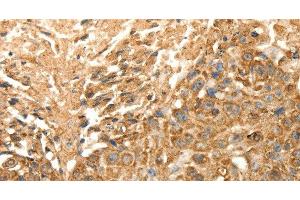Immunohistochemistry of paraffin-embedded Human esophagus cancer using SLC25A11 Polyclonal Antibody at dilution of 1:30 (SLC25A11 Antikörper)