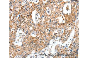 Immunohistochemistry of Human lung cancer using BAX Polyclonal Antibody at dilution of 1:30 (BAX Antikörper)