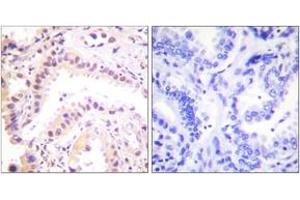Immunohistochemistry analysis of paraffin-embedded human lung carcinoma tissue, using Cullin 2 Antibody. (Cullin 2 Antikörper  (AA 696-745))