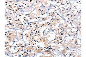 The image on the left is immunohistochemistry of paraffin-embedded Human thyroid cancer tissue using ABIN7128792(CATSPER1 Antibody) at dilution 1/40, on the right is treated with fusion protein. (CATSPER1 Antikörper)