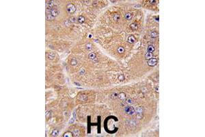 Formalin-fixed and paraffin-embedded human hepatocellular carcinoma reacted with FUCA2 polyclonal antibody  , which was peroxidase-conjugated to the secondary antibody, followed by DAB staining.