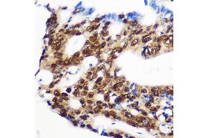 Immunohistochemistry of paraffin-embedded Human colon carcinoma using RBM15 Rabbit pAb (ABIN1682491, ABIN3019286, ABIN3019287, ABIN5664924 and ABIN6220805) at dilution of 1:100 (40x lens). (RBM15 Antikörper  (AA 530-780))