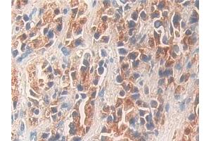Detection of KLK11 in Human Prostate cancer Tissue using Polyclonal Antibody to Kallikrein 11 (KLK11) (Kallikrein 11 Antikörper  (AA 39-282))
