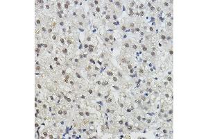 Immunohistochemistry of paraffin-embedded human liver cancer using BRAP Rabbit pAb (ABIN7265922) at dilution of 1:100 (40x lens). (BRAP Antikörper  (AA 1-200))
