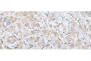 Immunohistochemistry of paraffin-embedded Human liver cancer tissue using BDNF Polyclonal Antibody at dilution of 1:65(x200)