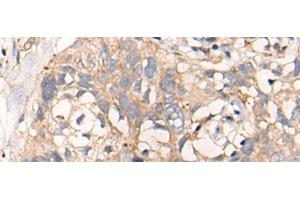 Immunohistochemistry of paraffin-embedded Human lung cancer tissue using NREP Polyclonal Antibody at dilution of 1:35(x200) (NREP Antikörper)