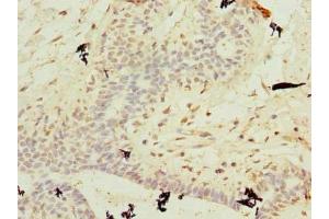 Immunohistochemistry of paraffin-embedded human breast cancer using ABIN7174699 at dilution of 1:100 (AKNA Domain Containing 1 (AKNAD1) (AA 1-223) Antikörper)