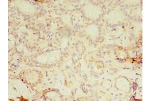Immunohistochemistry of paraffin-embedded human breast cancer using ABIN7157249 at dilution of 1:100 (KBTBD4 Antikörper  (AA 151-415))