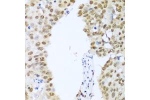 Immunohistochemistry of paraffin-embedded human lung cancer using HDAC1 antibody. (HDAC1 Antikörper  (AA 393-482))