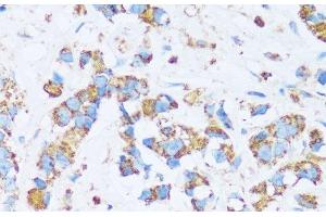 Immunohistochemistry of paraffin-embedded Human breast cancer using CA13 Polyclonal Antibody at dilution of 1:100 (40x lens).