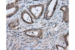 Immunohistochemical staining of paraffin-embedded Adenocarcinoma of colon tissue using anti-TPMT mouse monoclonal antibody. (TPMT Antikörper)